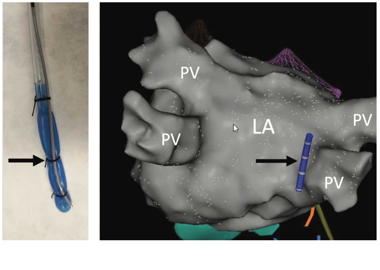 Alsheikh Catheter Ablation Figure 4