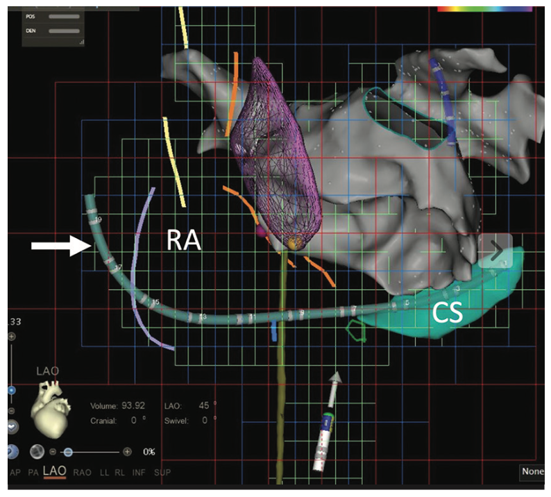 Alsheikh Catheter Ablation Figure 5