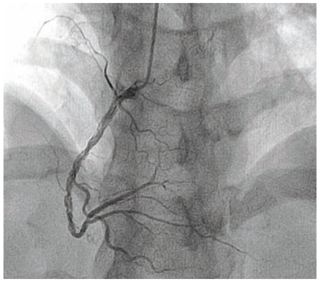Alzayer Acute Coronary Syndrome Figure 3