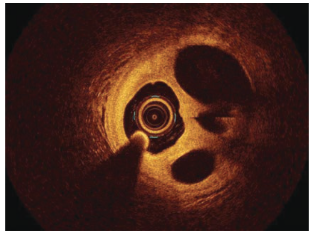 Alzayer Acute Coronary Syndrome Figure 4