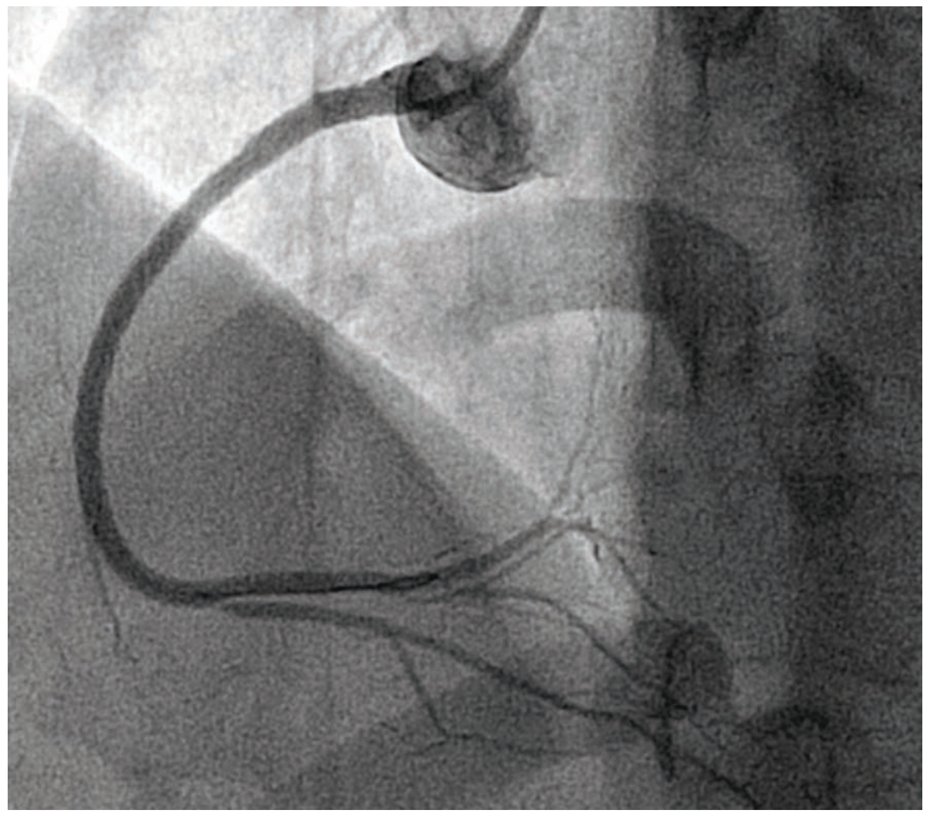 Alzayer Acute Coronary Syndrome Figure 5