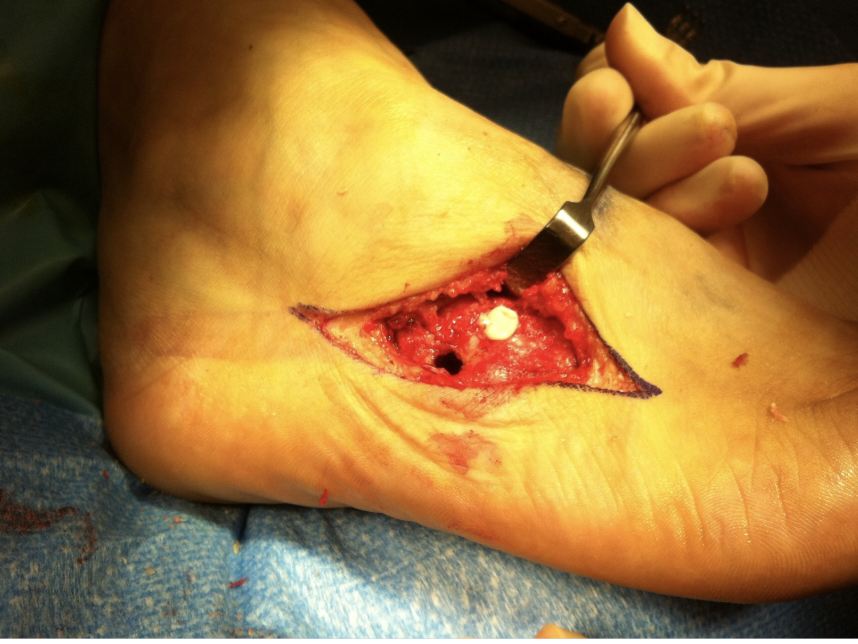 In cases that have failed conservative treatment, consider an anchovy tendon interposition. 