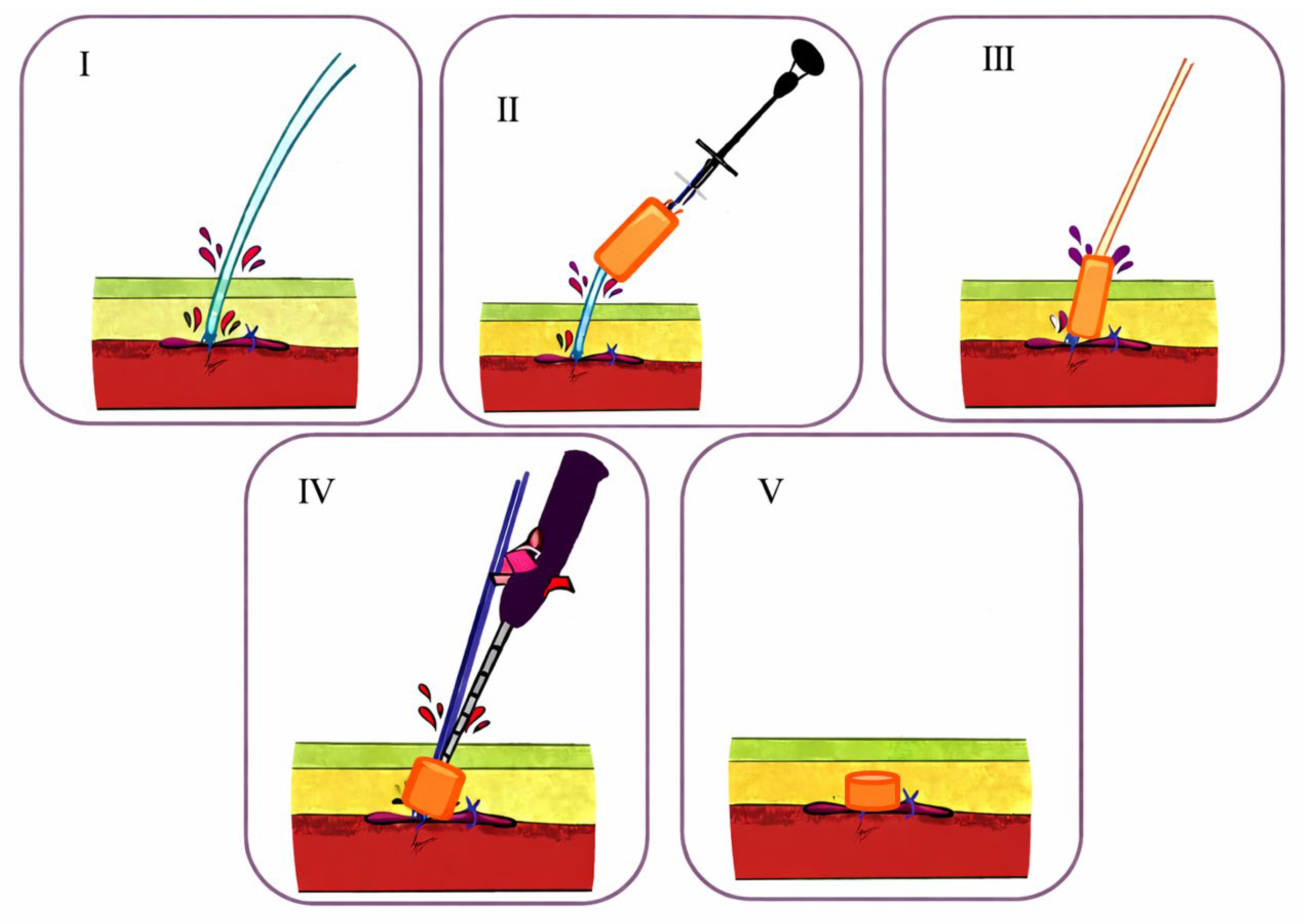 Central illustration. SAFE-SEAL Bail-Out Technique