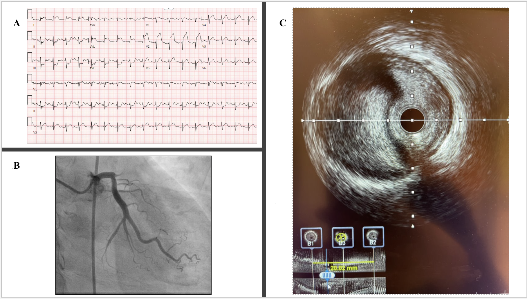 Figure.  (A) Electrocardiogram at arrival. (B) Right anterior oblique-caudal angiogram. (C) Intravascular ultrasound image.