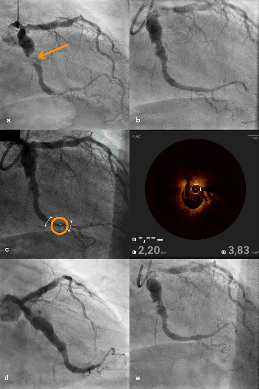 Figure. Serial imaging of the culprit lesion. 