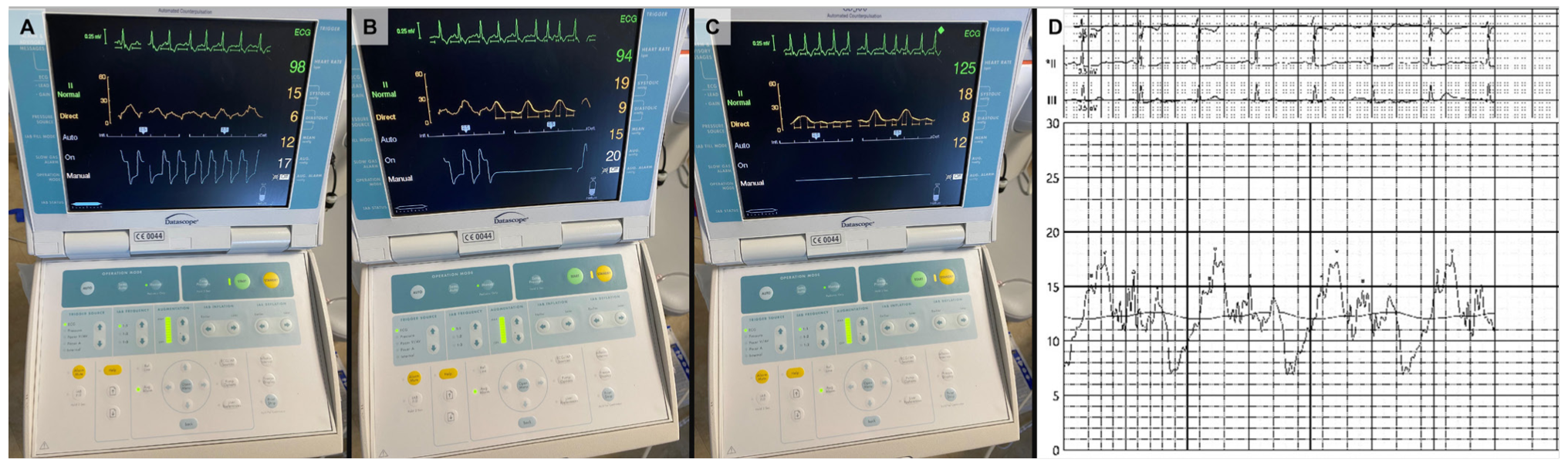 Araj Balloon Pump Figure 2