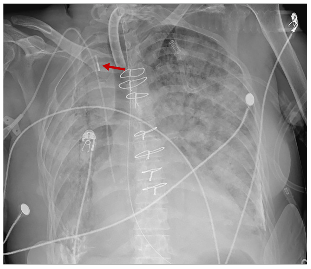 Araj Balloon Pump Figure 3