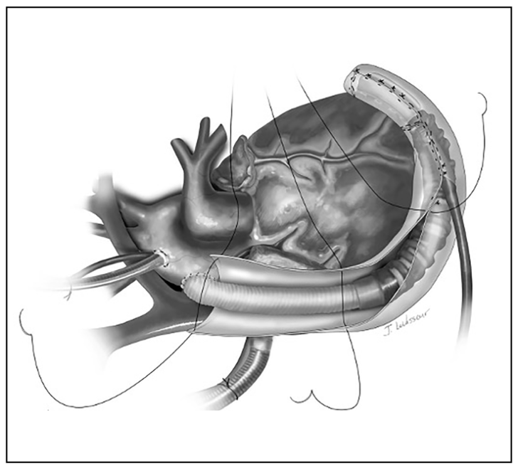 Araj Graft Obstruction Figure 1