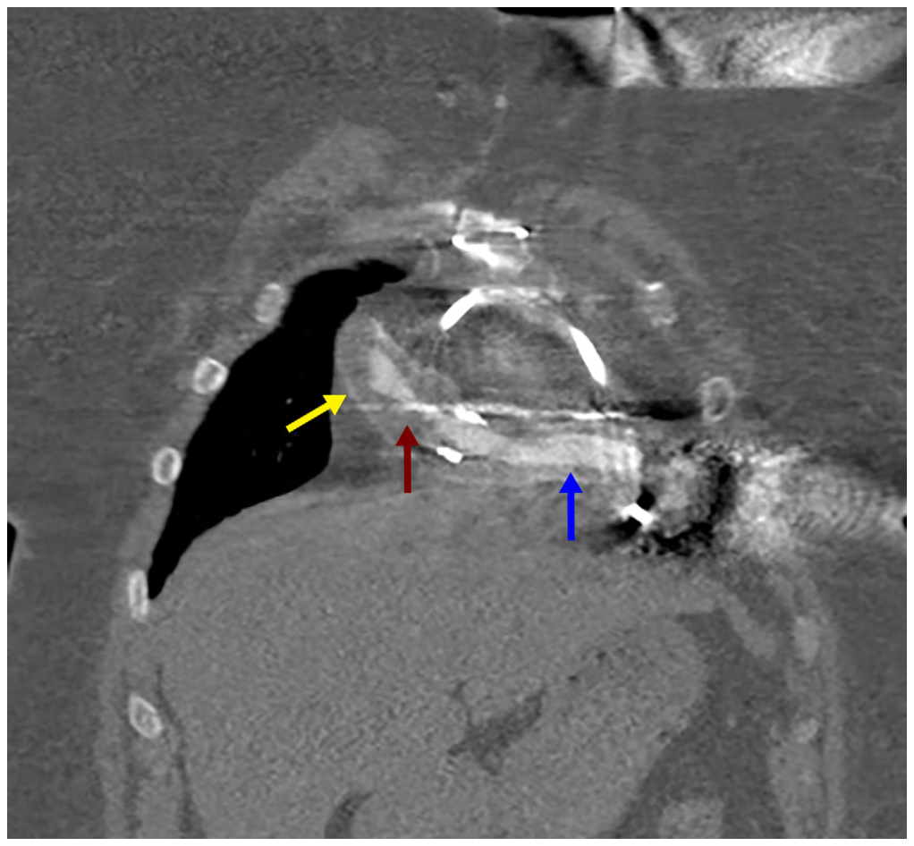 Araj Graft Obstruction Figure 3