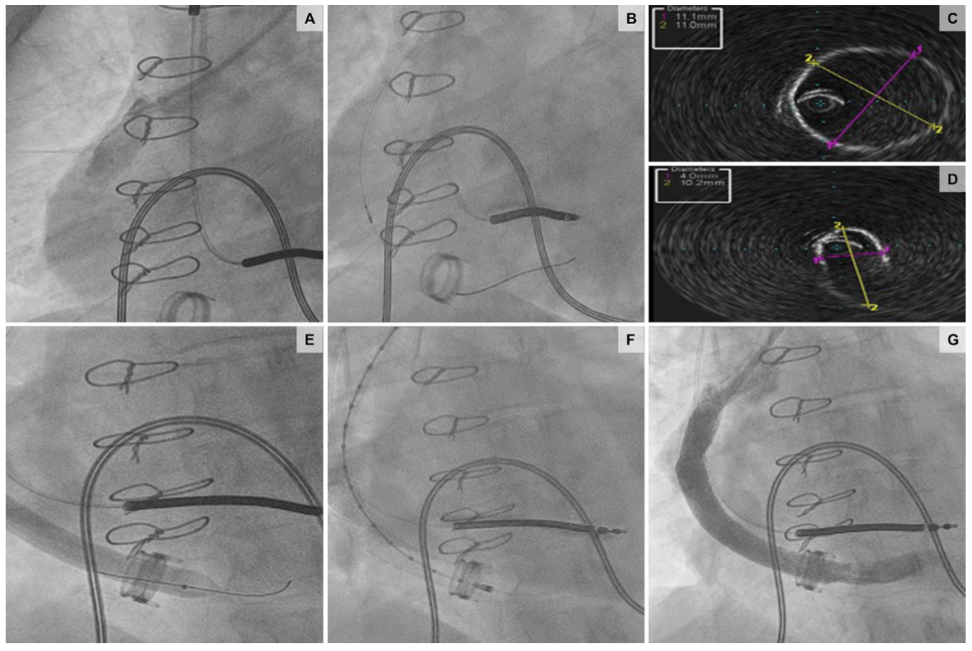 Araj Graft Obstruction Figure 4