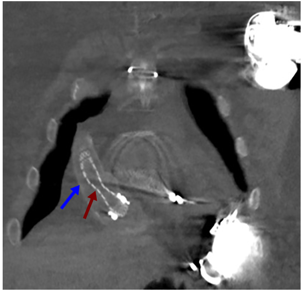 Araj Graft Obstruction Figure 5
