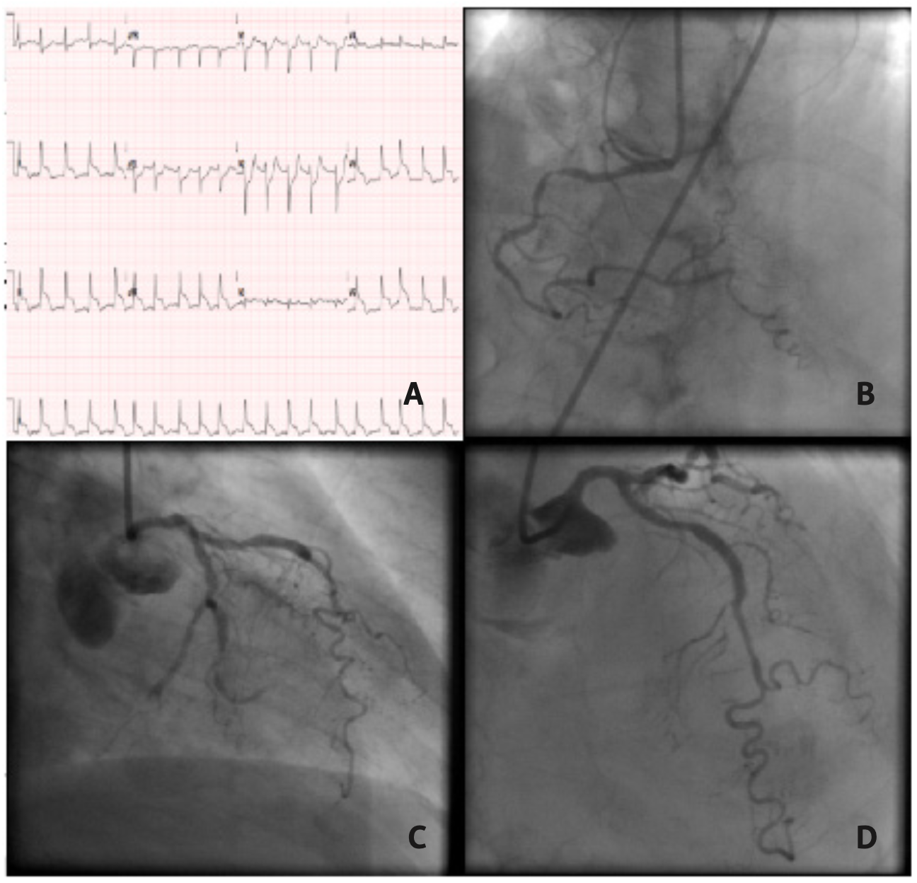 Araujo STEMI Figure 1