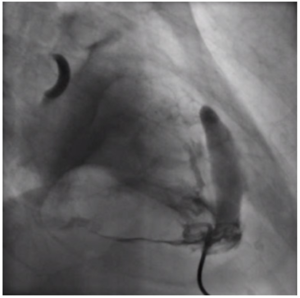 Araujo STEMI Figure 2