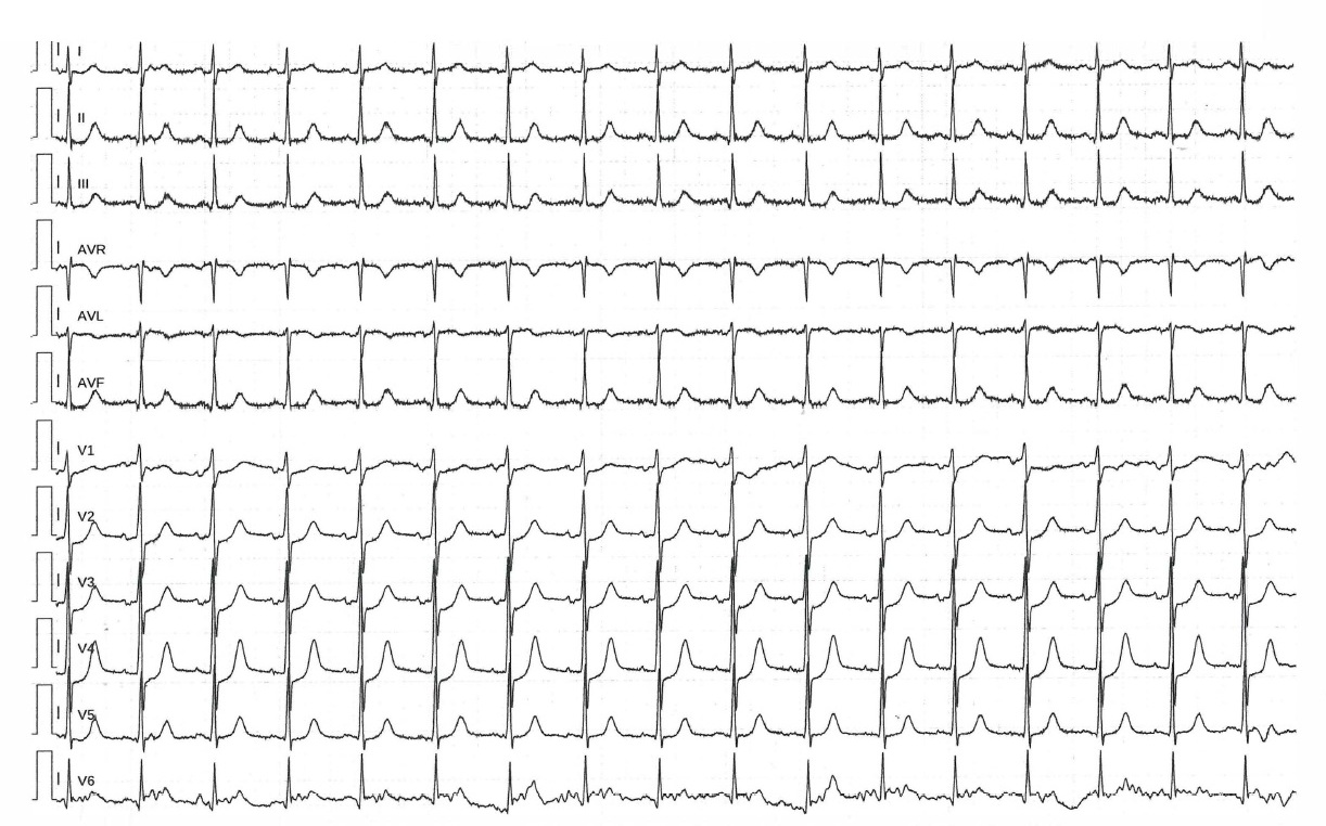 Figure 1. Twelve-lead electrocardiogram showing an ST-segment depression in leads V2 to V4.
