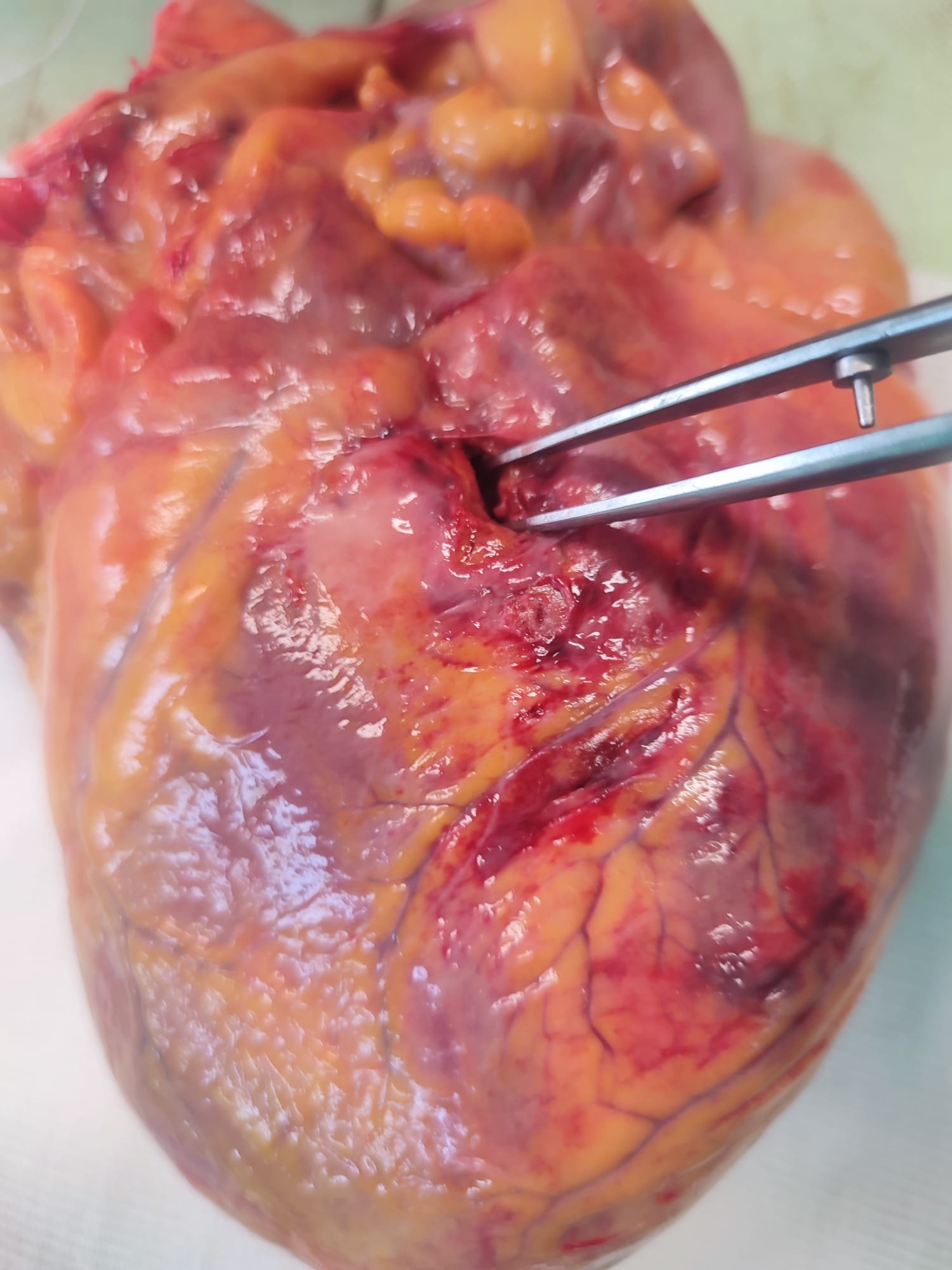 Figure 2. The autopsy revealed the cause of death: a rupture to the anterior left ventricle free wall.