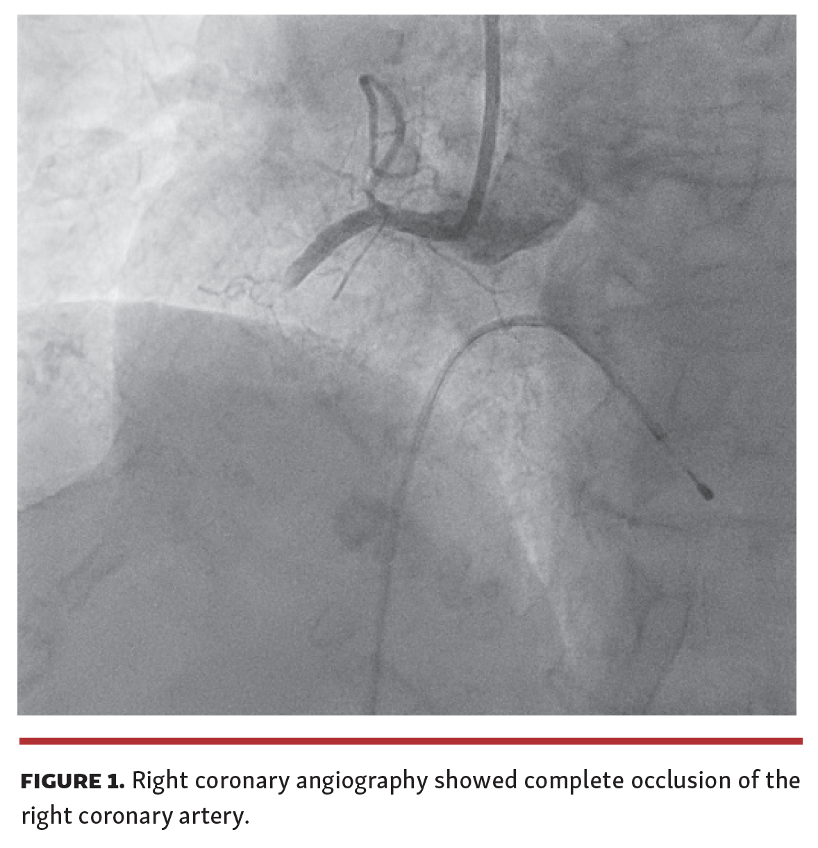  Arrivi Manual Coronary Thrombectomy in Primary PCI Fig 1