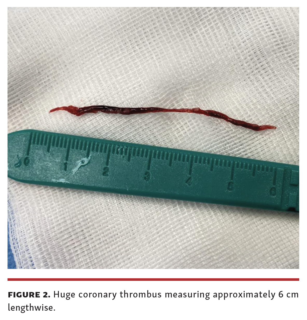 Arrivi Manual Coronary Thrombectomy in Primary PCI Fig 2