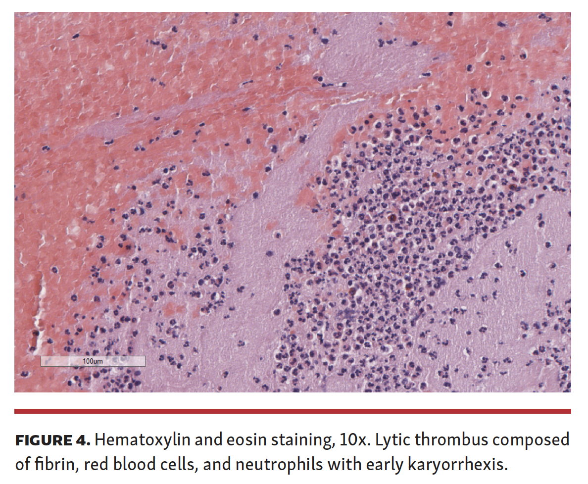 Arrivi Manual Coronary Thrombectomy in Primary PCI Fig 4