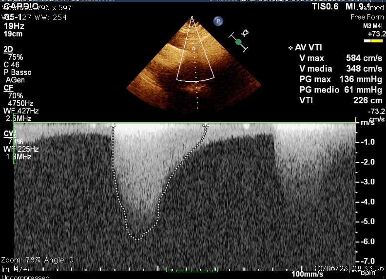 Figure 2. High transjugular Doppler-ultrasound gradient
