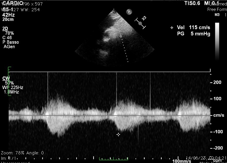 Figure 3. Normalized transjugular Doppler-ultrasound gradient