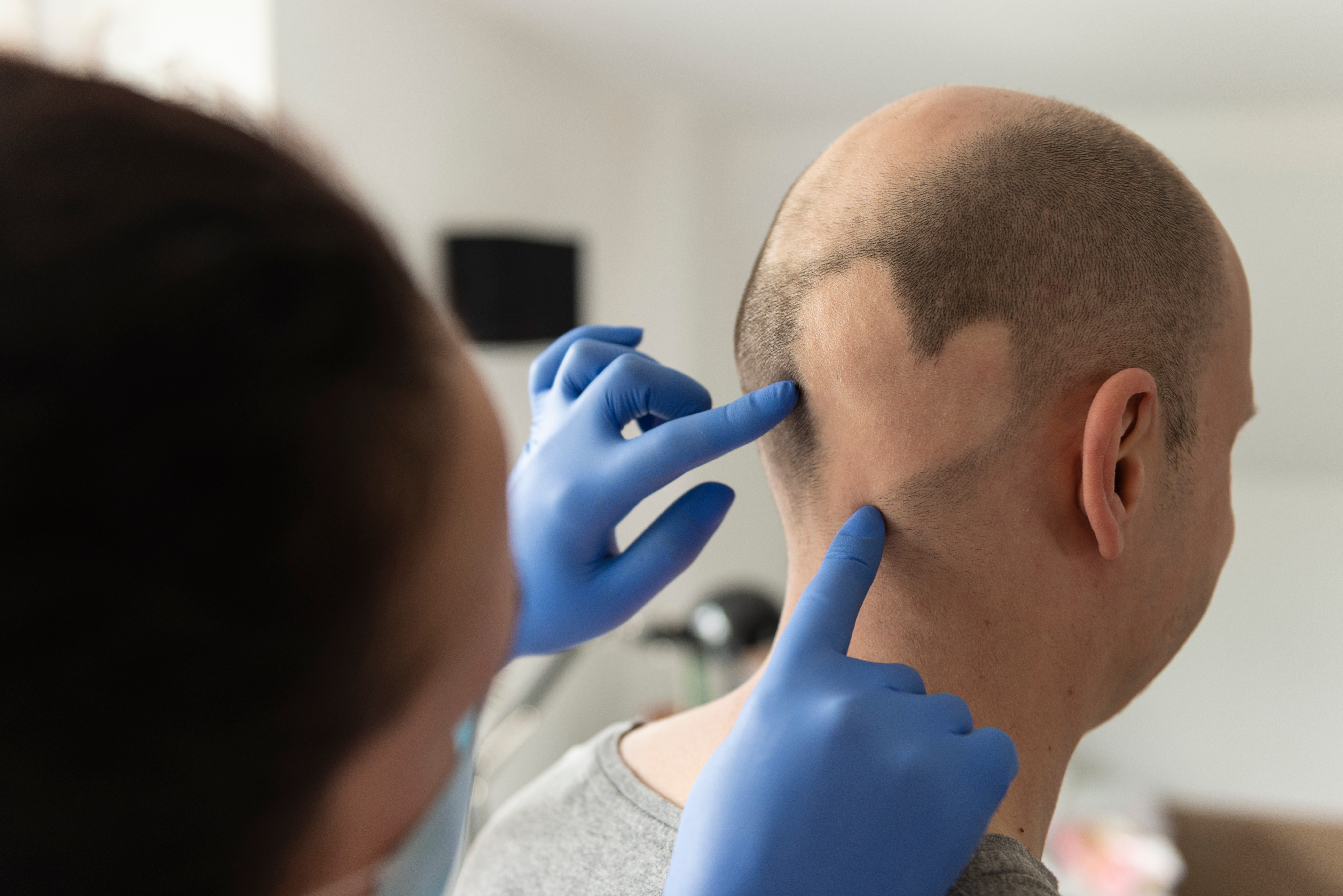 AA patient with heart shaped hair loss patch examined by doctor