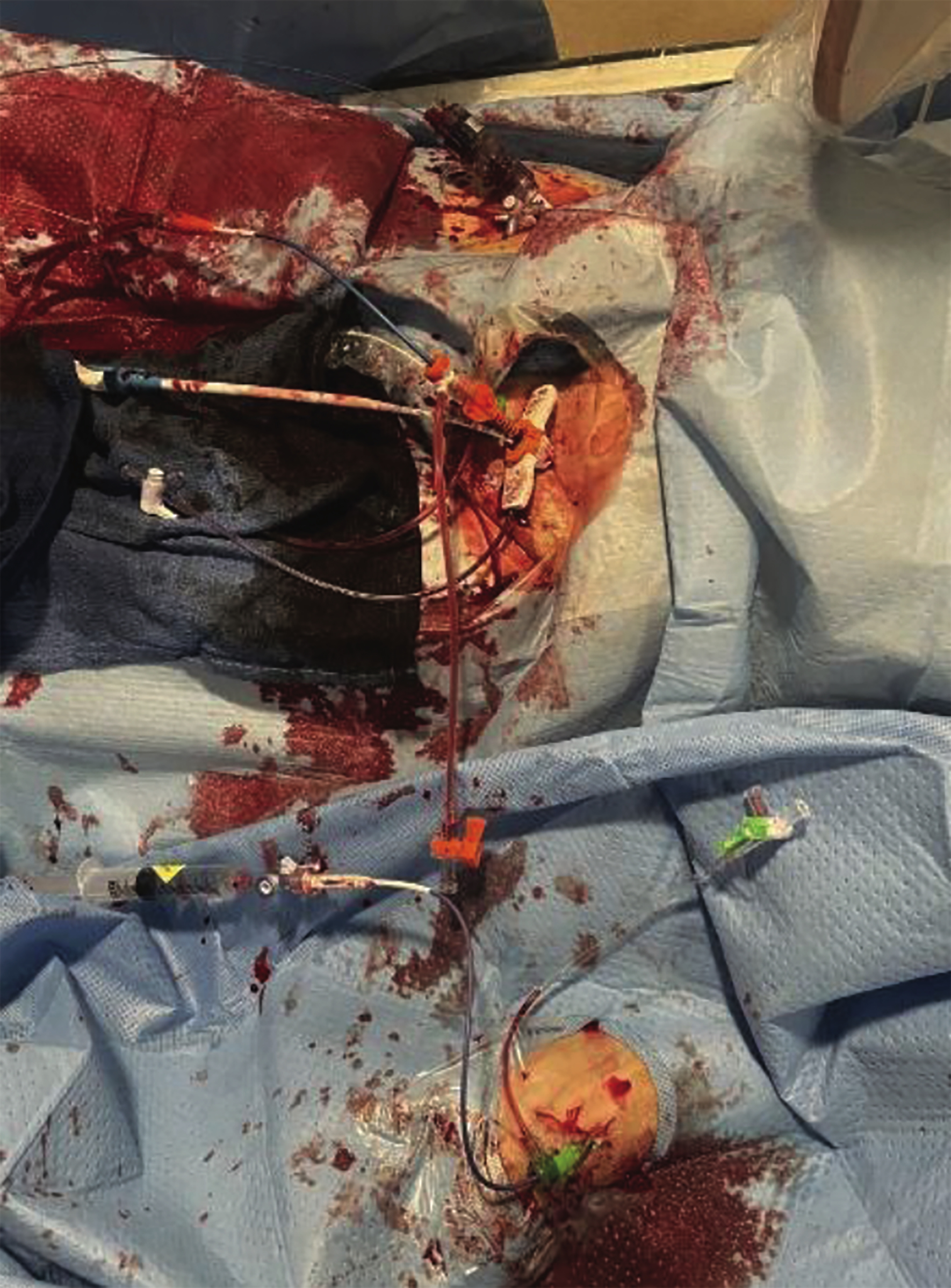 Figure 2. Using bifemoral and left radial 6 French access, a transvenous pacing wire was inserted through the left common femoral vein. The right common femoral artery was upsized to accommodate the valve delivery sheath, while the left common femoral artery was upsized for the Impella sheath.