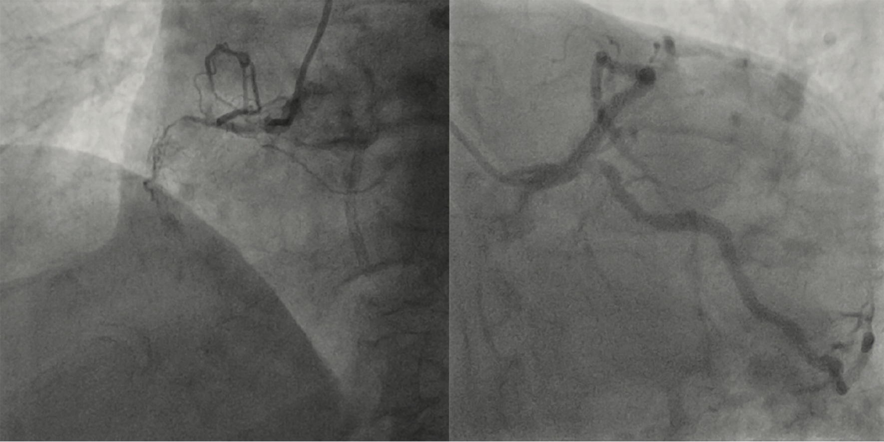 Figure 1. Left heart catheterization demonstrating severe two-vessel coronary artery disease (100% ostial circumflex, 100% proximal right coronary artery).