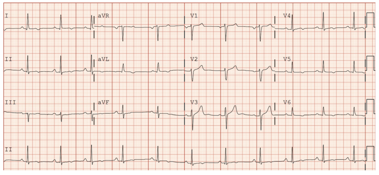 Ayinde Left Bundle Branch Figure 1