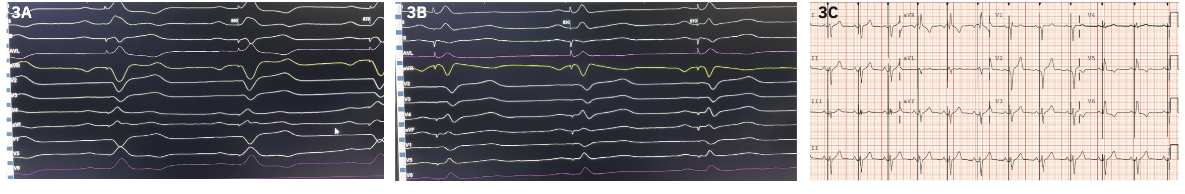 Ayinde Left Bundle Branch Figure 3