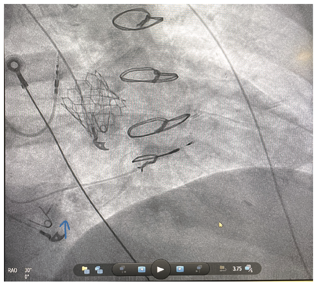Ayinde Left Bundle Branch Figure 4