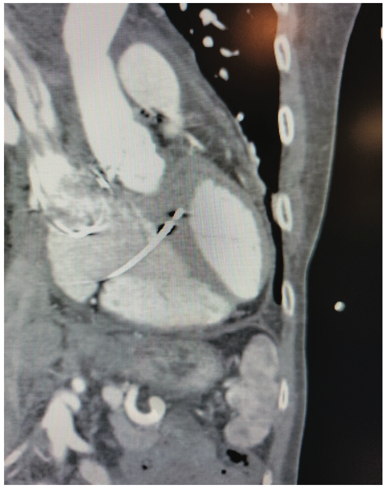 Ayinde Left Bundle Branch Figure 8