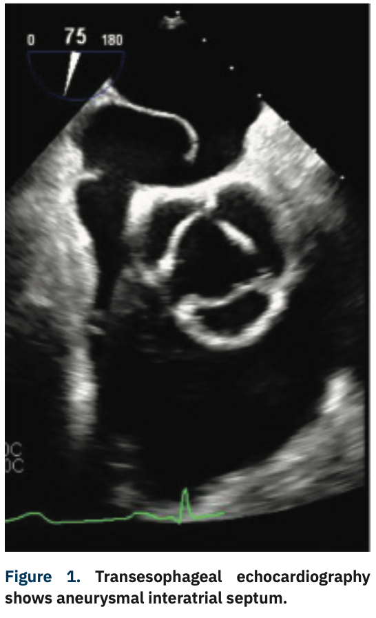 Bakhsh Platypnea-Orthodeoxia Figure 1