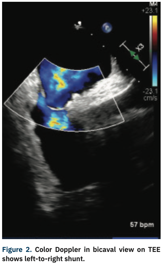 Bakhsh Platypnea-Orthodeoxia Figure 2