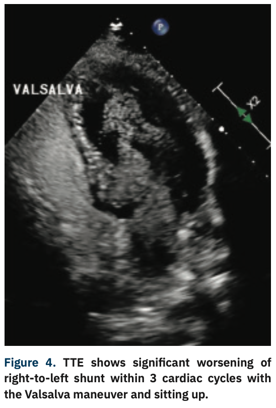 Bakhsh Platypnea-Orthodeoxia Figure 4