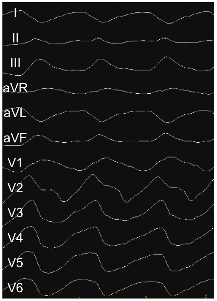 Barbhaiya Ventricular Tachycardia Figure 2