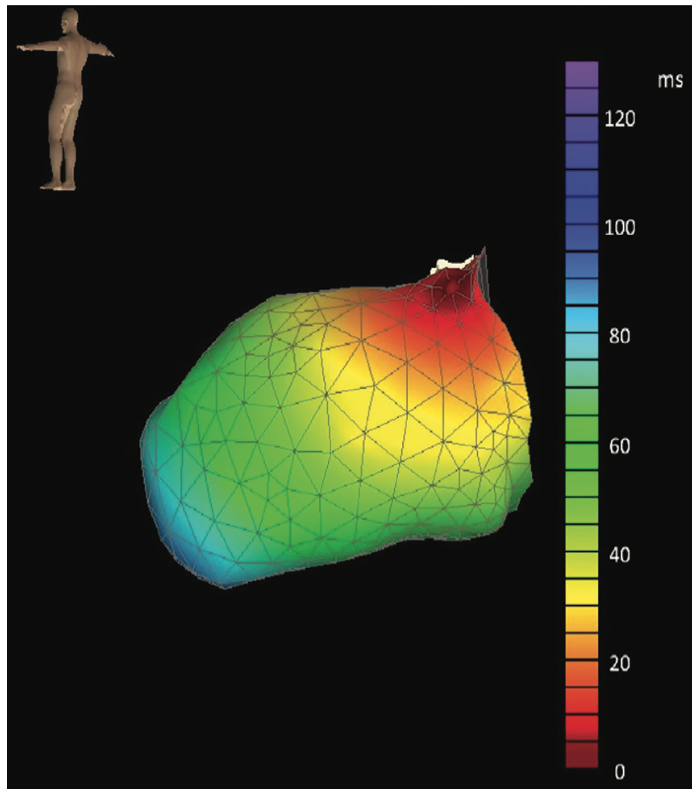 Barbhaiya Ventricular Tachycardia Figure 3