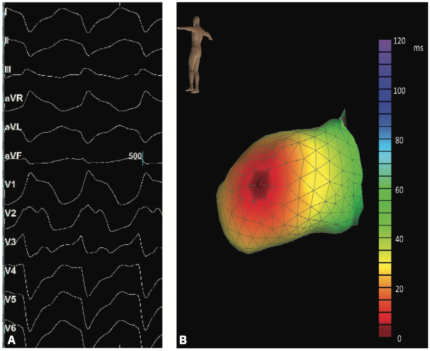 Barbhaiya Ventricular Tachycardia Figure 4