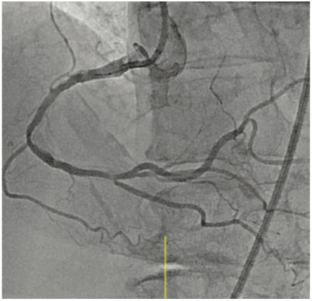 Baron Calcified Lesions Figure 1A