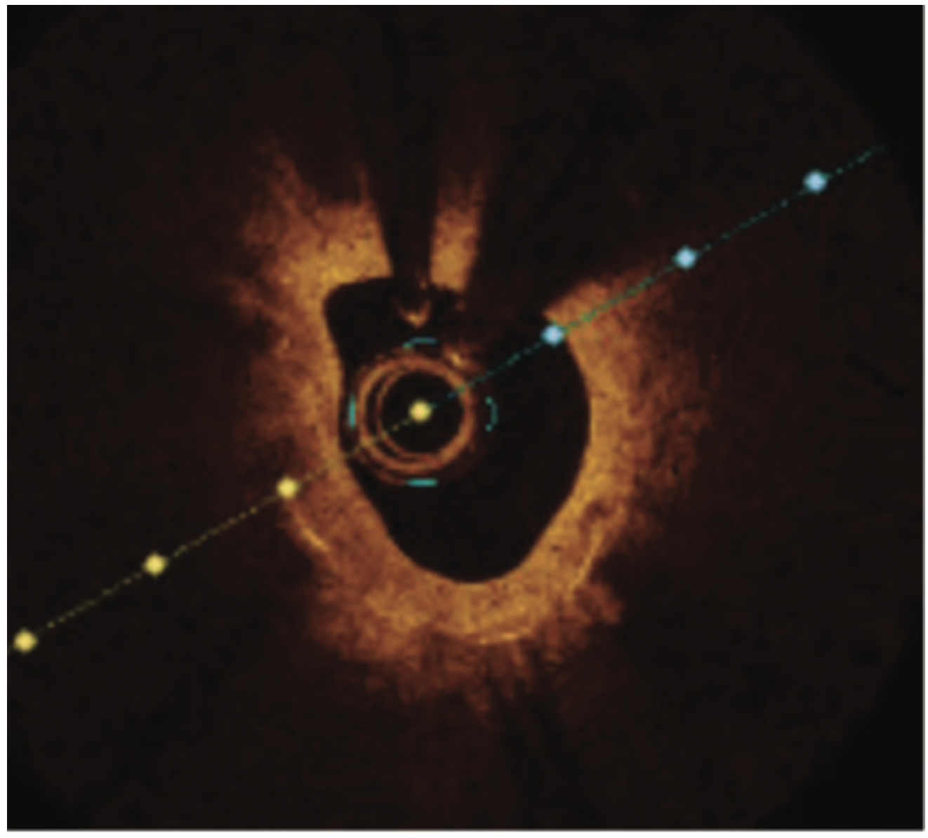 Baron Calcified Lesions Figure 1B