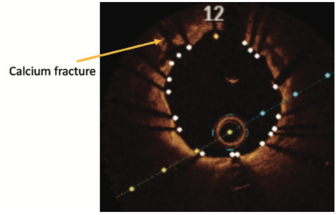 Baron Calcified Lesions Figure 1C