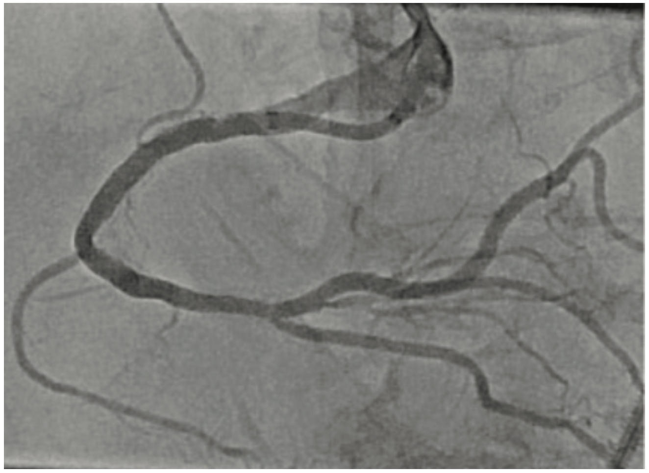 Baron Calcified Lesions Figure 1D