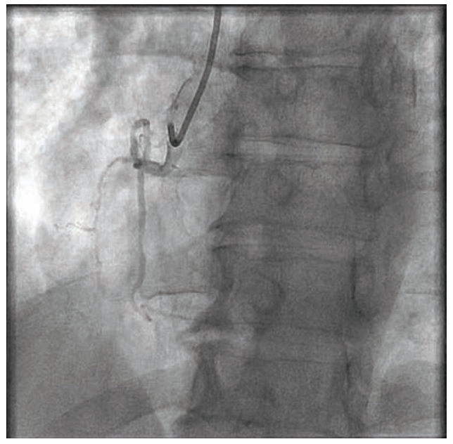 Baron Stent Figure 1