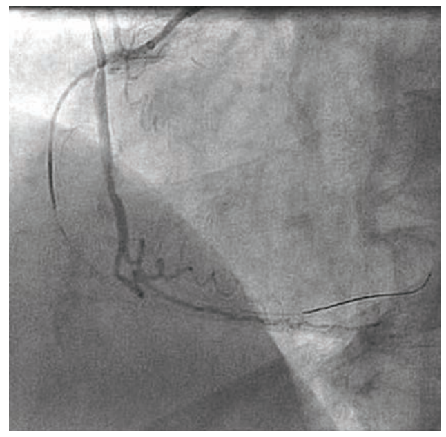 Baron Stent Figure 2
