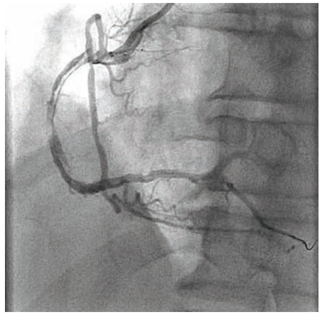 Baron Stent Figure 3