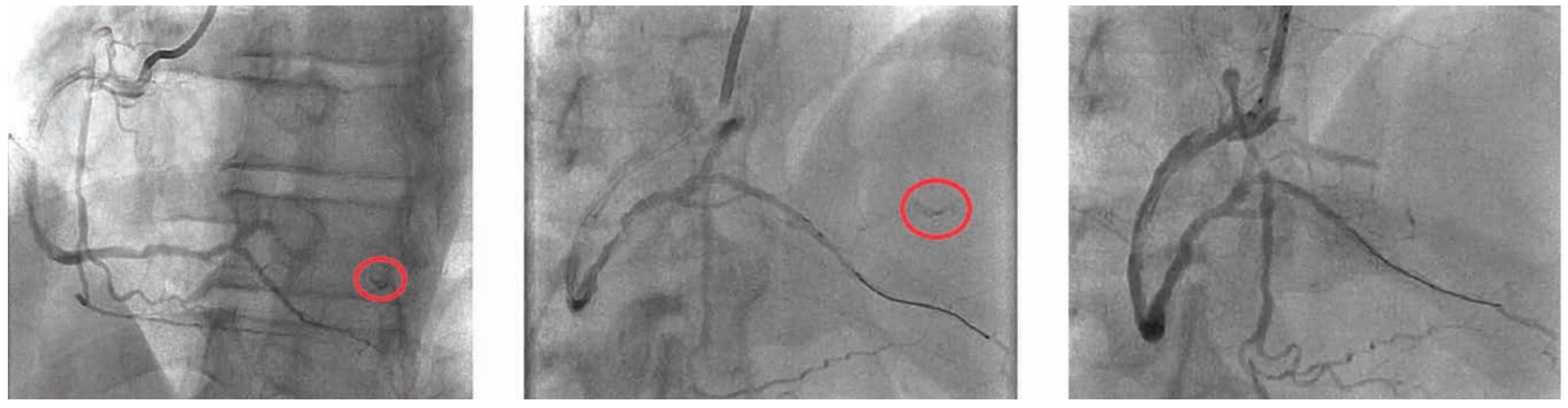 Baron Stent Figure 4