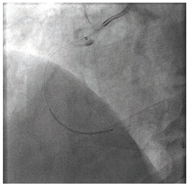 Baron Stent Figure 5