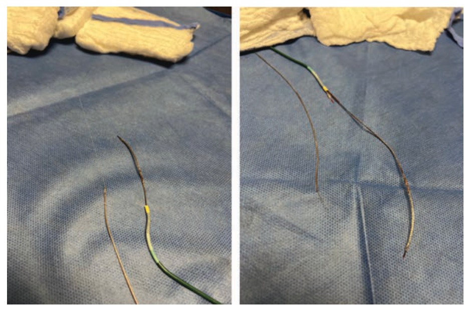 Baron Stent Figure 6