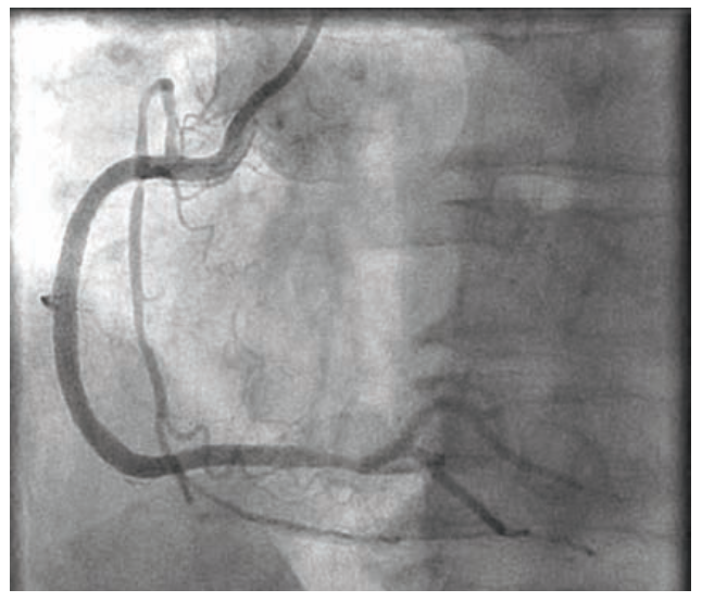 Baron Stent Figure 7