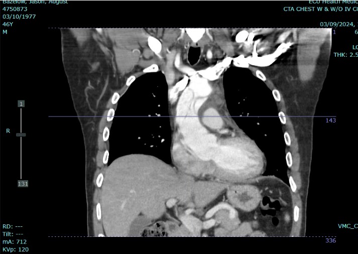 CT Scan showing aortic dissection