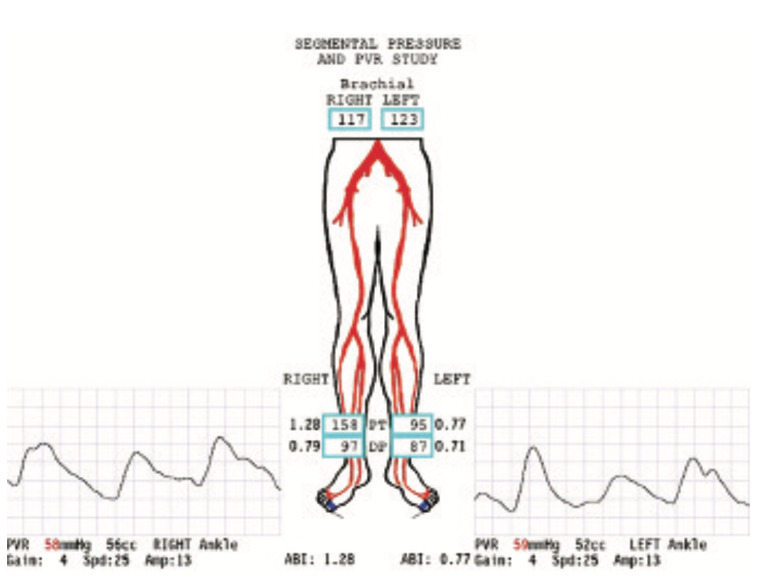 Beasley-Yates MicroMedical Stent Figure 1
